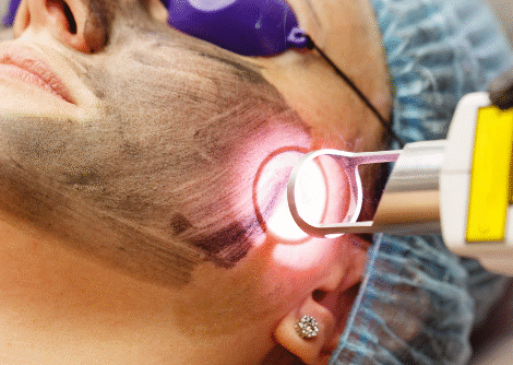 LASER Therapy LASER Therapy