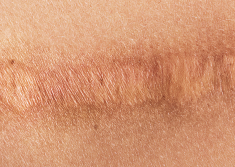 Scar Reduction Scar Reduction